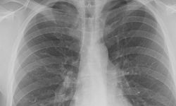 Akciğer Kanserinin nedenleri ve tedavisi